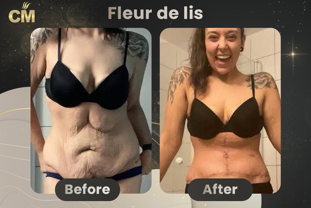 Fleur de lis abdominoplasty Before After