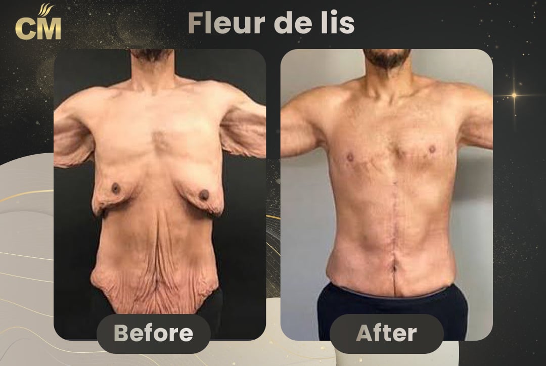 Fleur de lis abdominoplasty Before After-2