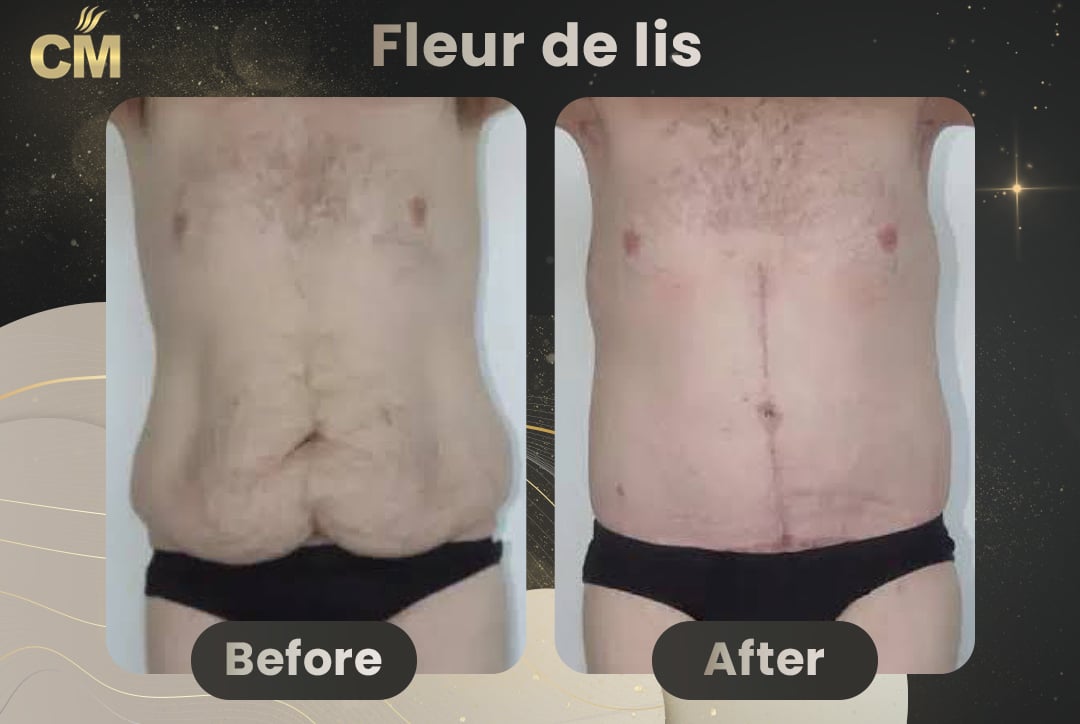 Fleur de lis abdominoplasty Before After-4