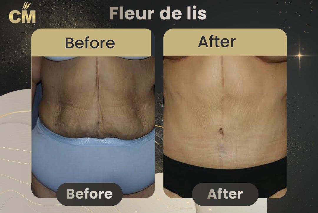 Fleur de lis abdominoplasty Before After-6
