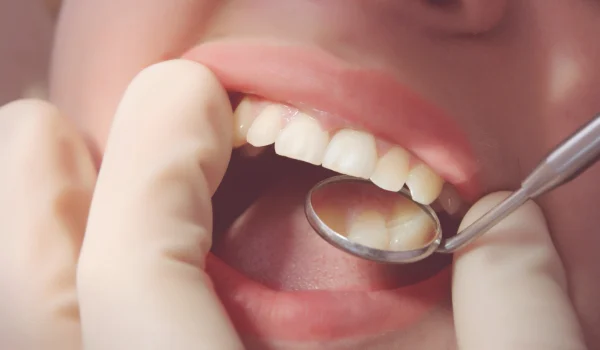 Dental Composite Fillings in Turkey