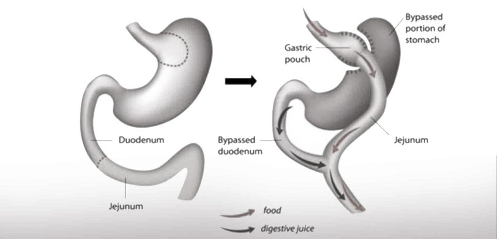 gastric bypass surgery