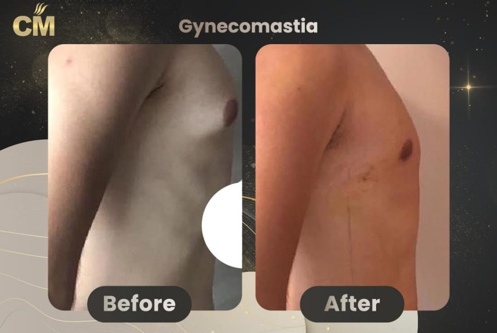 Gynecomastia Before and After in Turkey