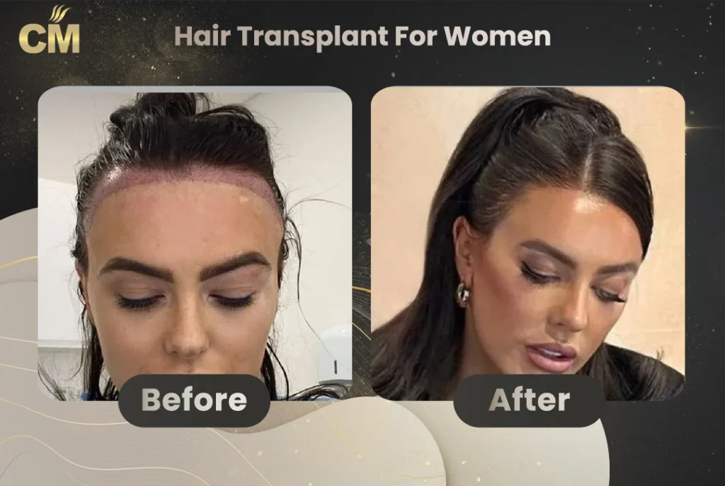 Hair Transplant For Women Before After in Turkey-5