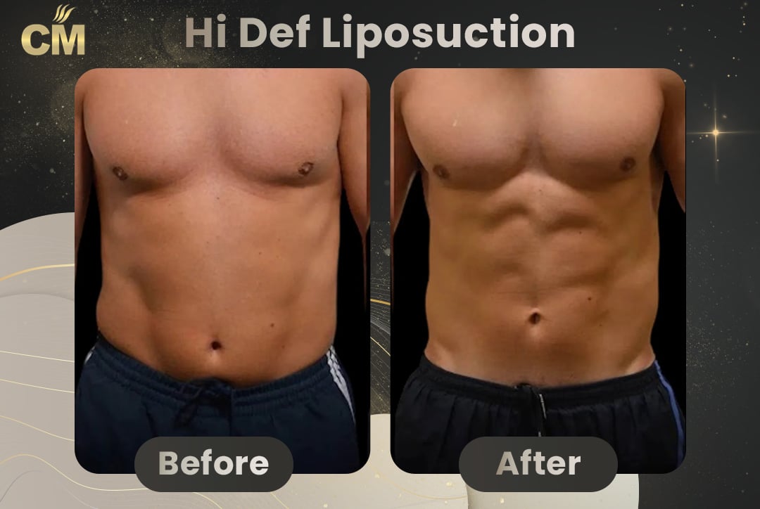 Hi Def Liposuction Before After-2