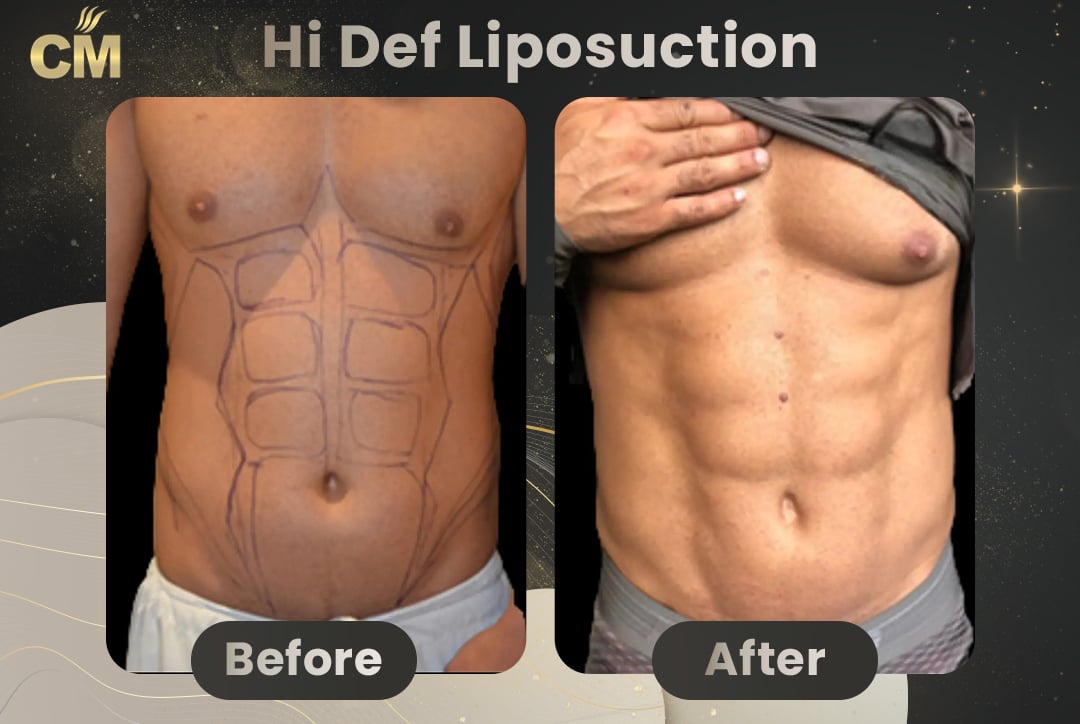 Hi Def Liposuction Before After-3