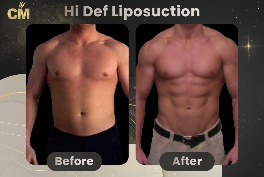 Hi Def Liposuction Before After-4
