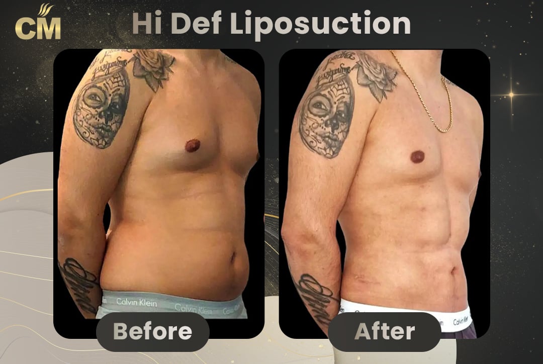 Hi Def Liposuction Before After-5