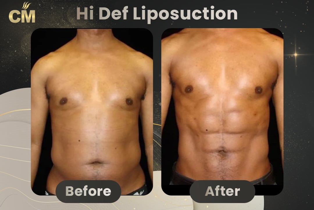 Hi Def Liposuction Before After-7