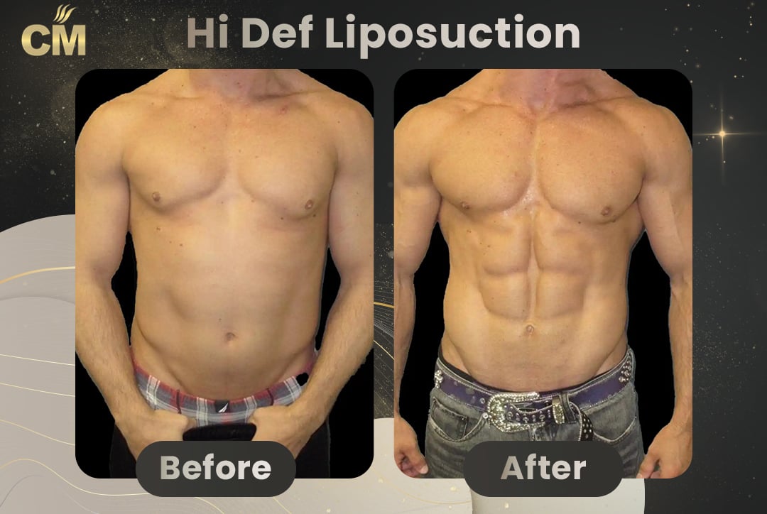 Hi Def Liposuction Before After-8