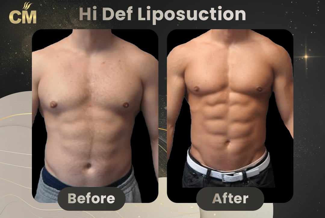 Hi Def Liposuction Before After-9