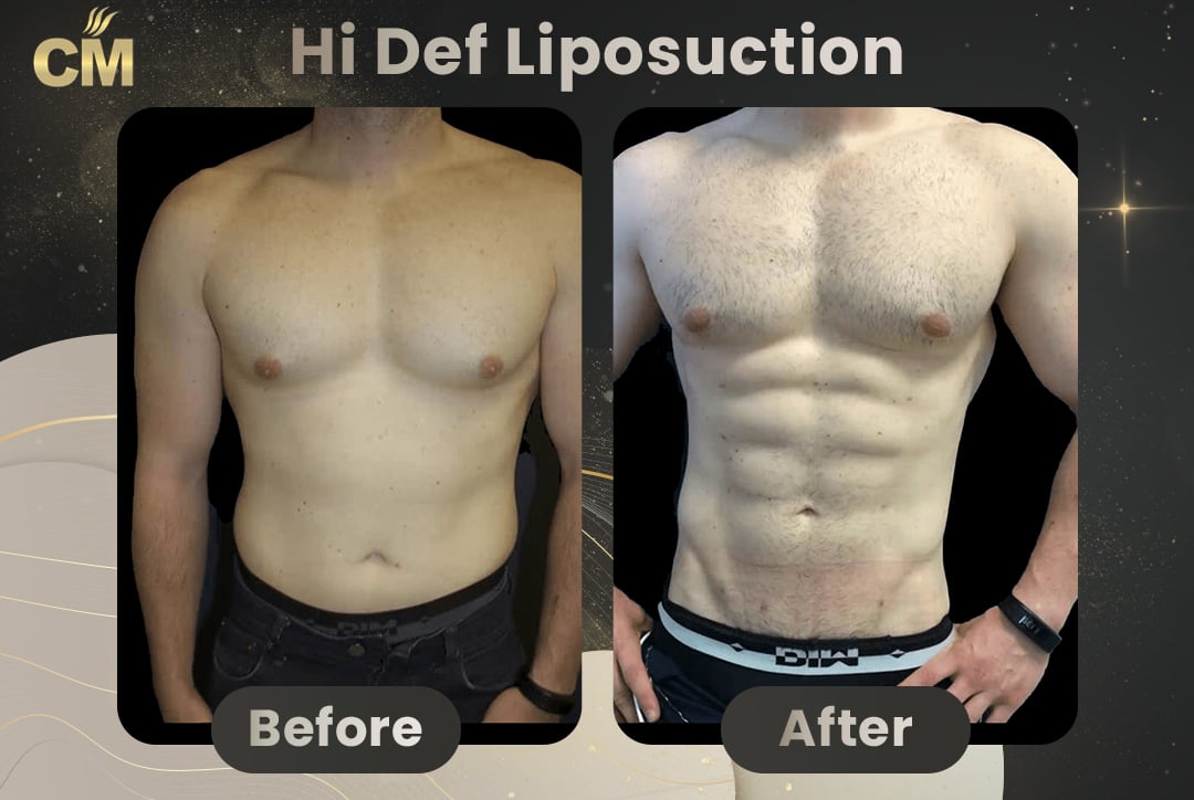Hi Def Liposuction Before After-10