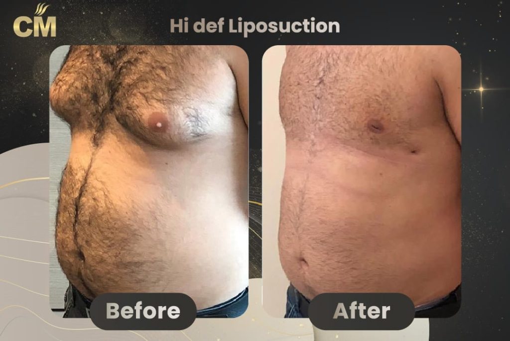 Liposuction For Men Before and After in Turkey