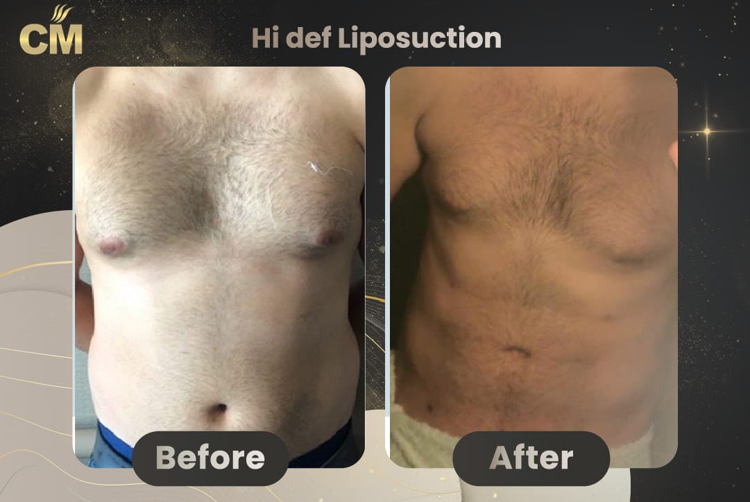 Hi Def Liposuction Before After-11