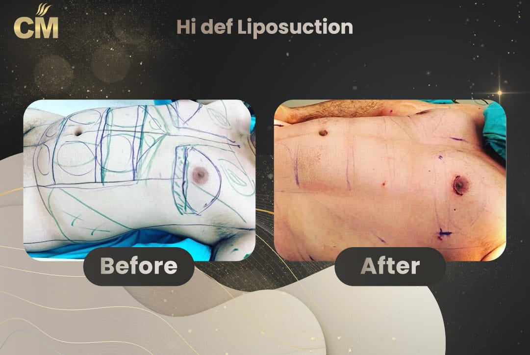 Hi Def Liposuction Before After-1