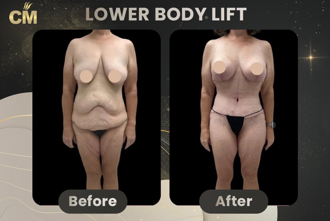 Back Lift (Bra Line Back Lift) Before After-13