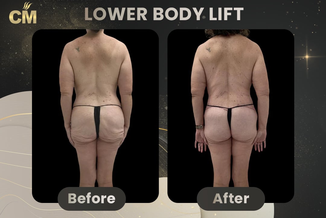 Back Lift (Bra Line Back Lift) Before After-22