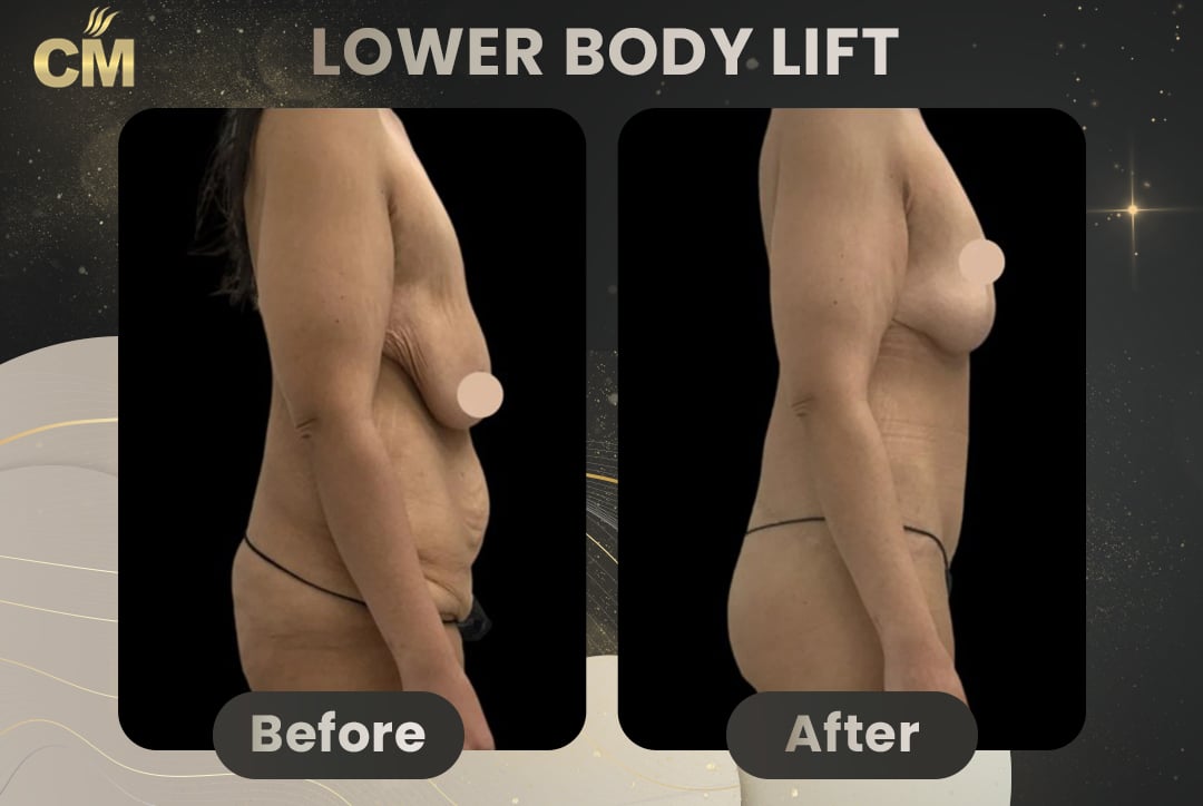 Back Lift (Bra Line Back Lift) Before After-14