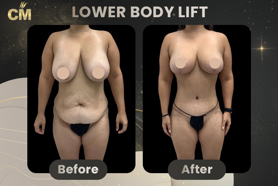 Back Lift (Bra Line Back Lift) Before After-15