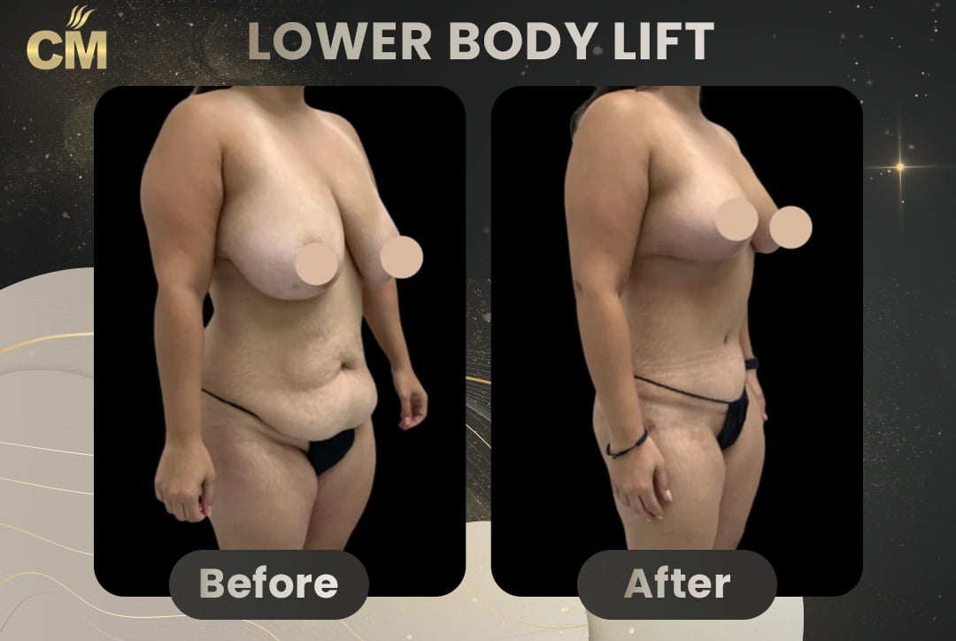 Back Lift (Bra Line Back Lift) Before After-16