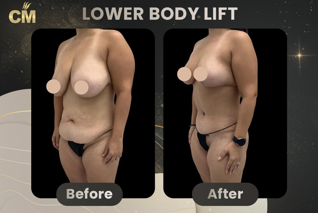Back Lift (Bra Line Back Lift) Before After-17