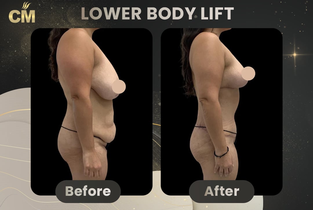 Back Lift (Bra Line Back Lift) Before After-18