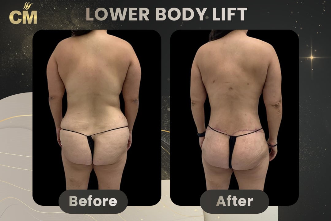 Back Lift (Bra Line Back Lift) Before After-19