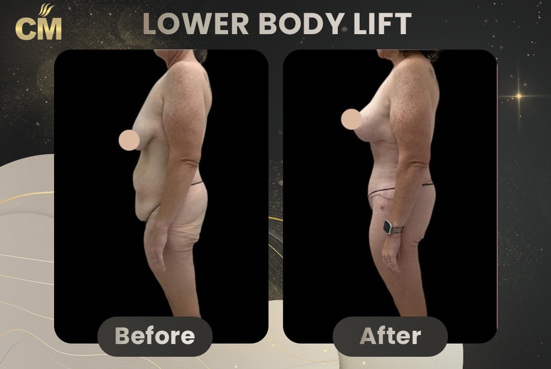 Back Lift (Bra Line Back Lift) Before After-21