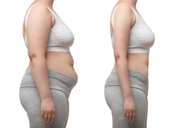 Life After Weight Loss in Turkey