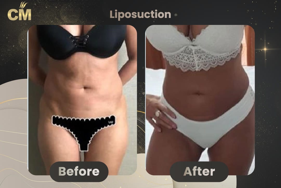 Vaser Liposuction Before and After