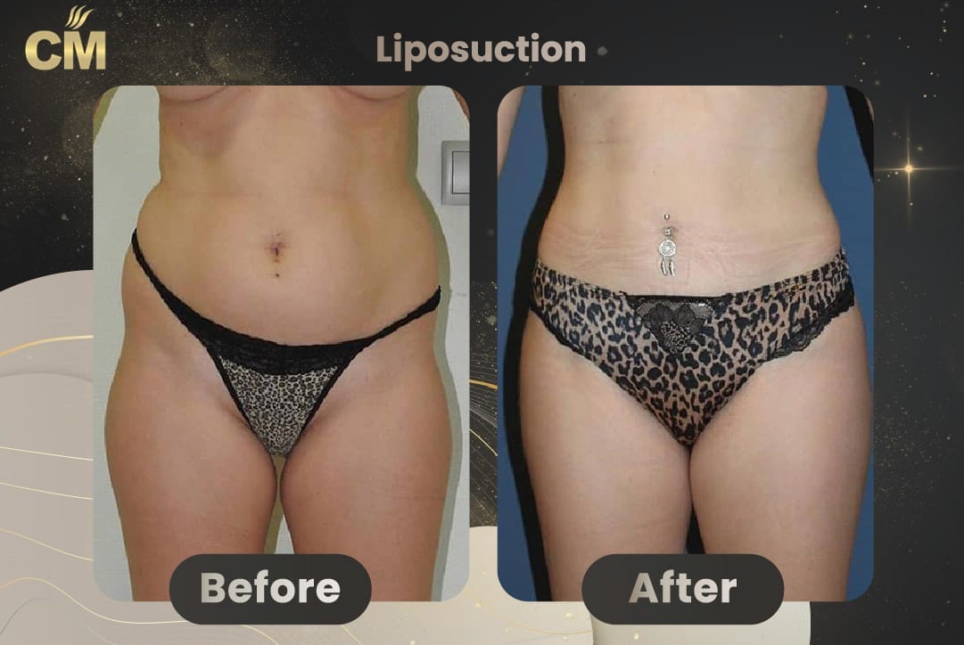 Vaser Liposuction Before and After-1