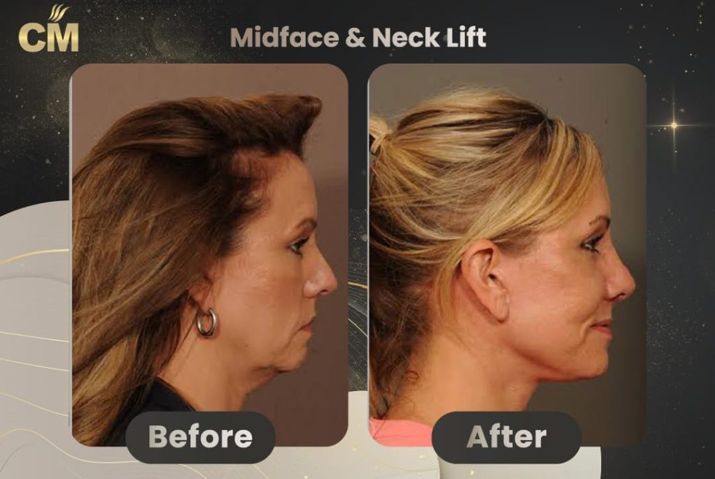 Neck Lift Before and After in Turkey