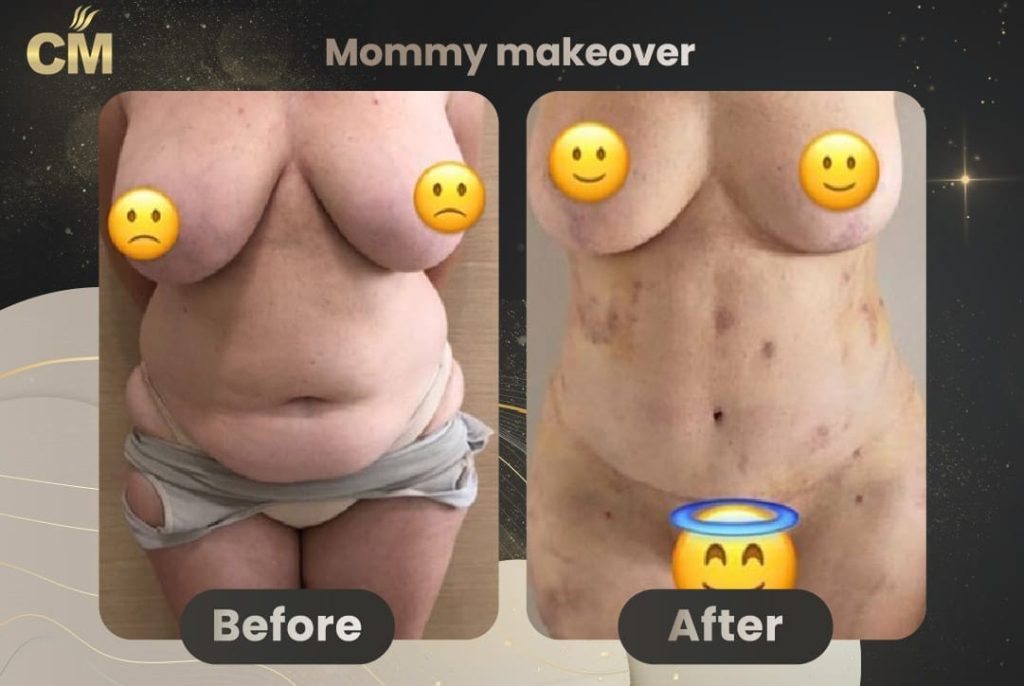 Mommy Makeover Before and After in Turkey
