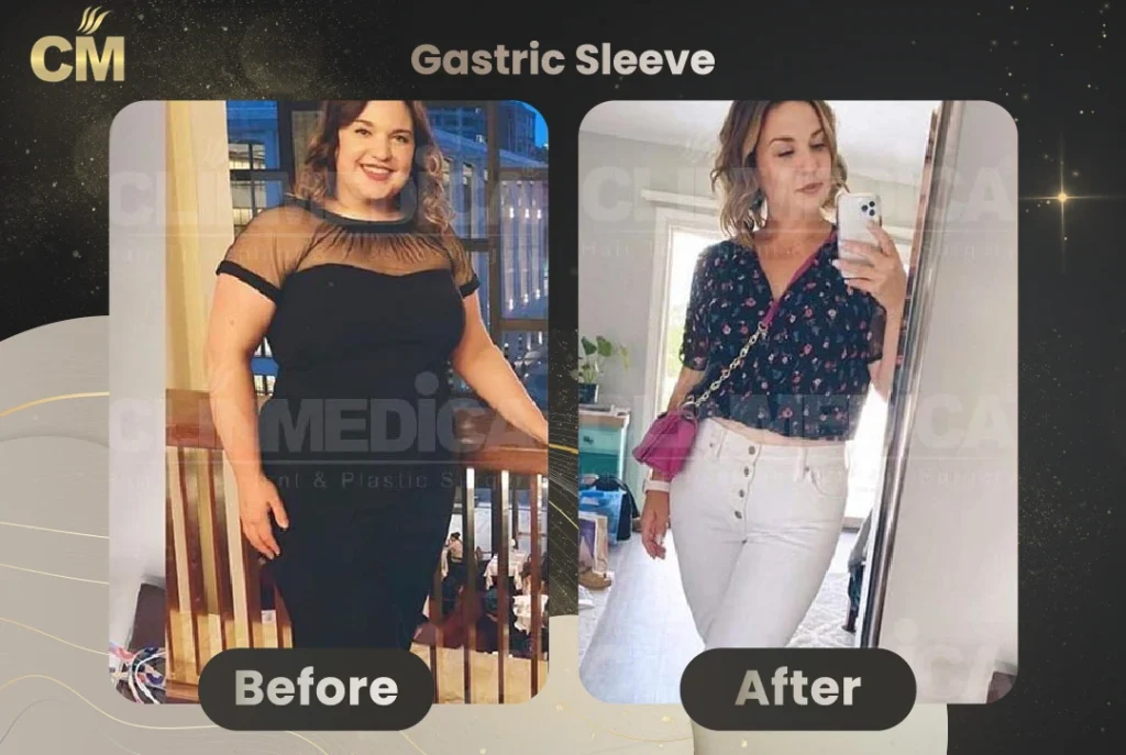 Obesity And Gastric Sleeve Before After in Turkey
