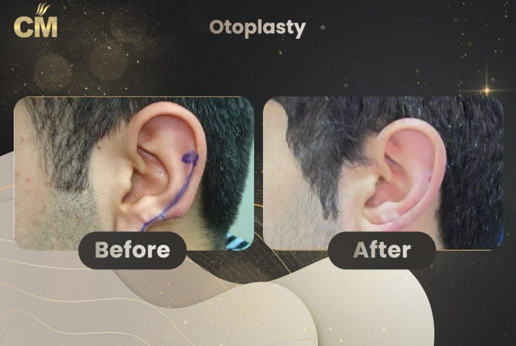 Otoplasty (Ear Surgery) Before After in Turkey