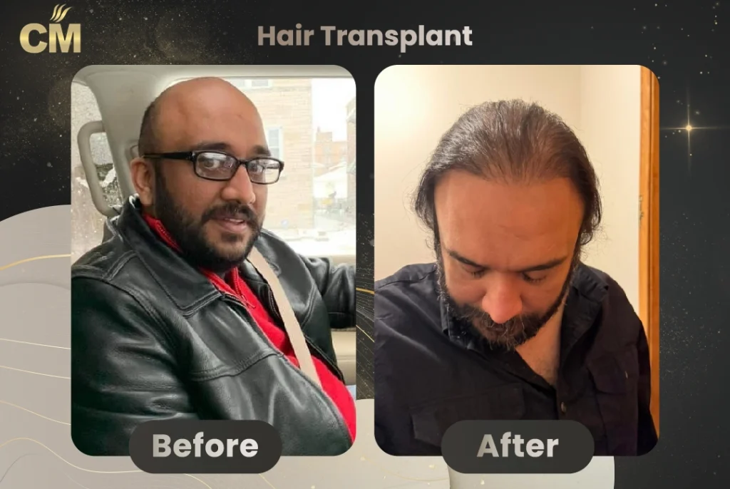 Sapphire Pen Hair Transplant Before and After in Turkey-2