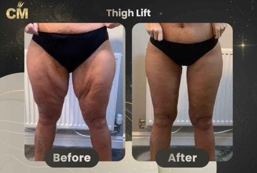 Thigh Lift Before and After in Turkey