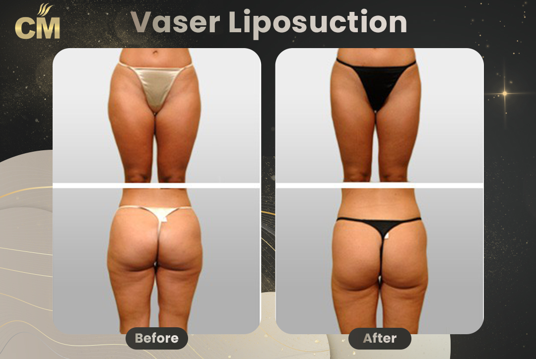 Vaser Liposuction Before and After-4