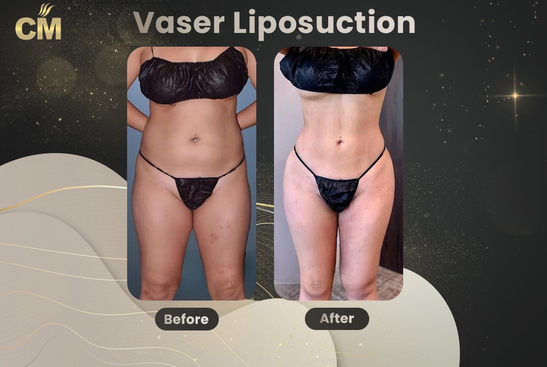 Vaser Liposuction Before and After-14