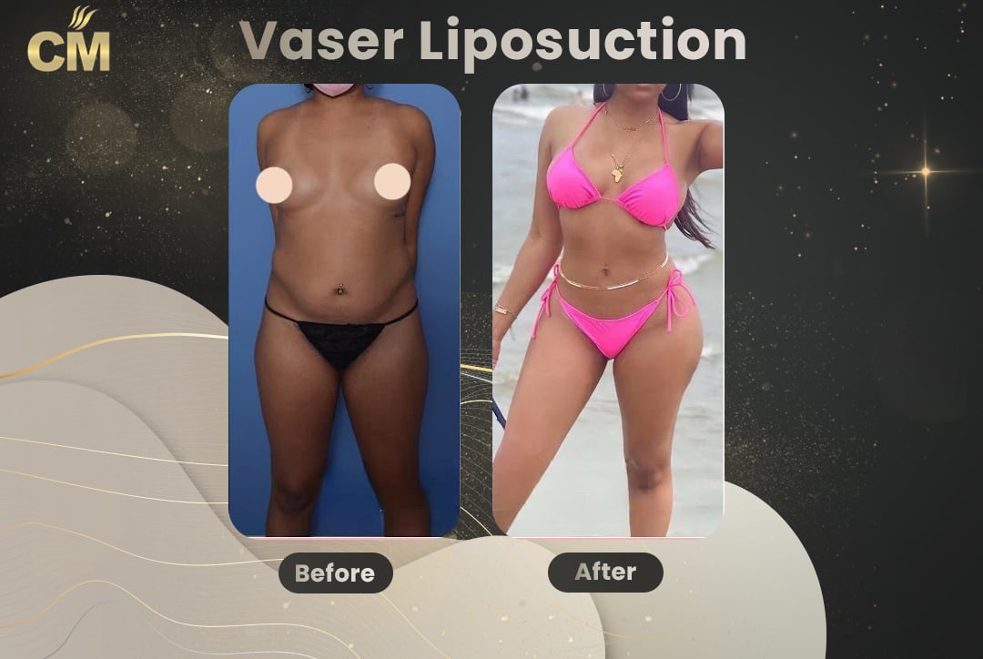 Vaser Liposuction Before and After-15