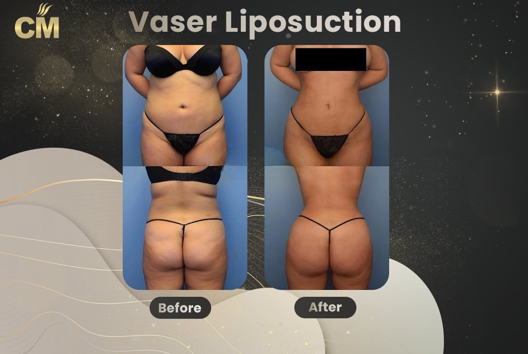 Vaser Liposuction Before and After-16