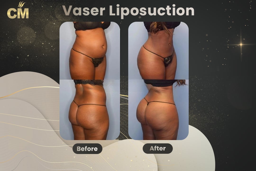 Vaser Liposuction Before and After-17