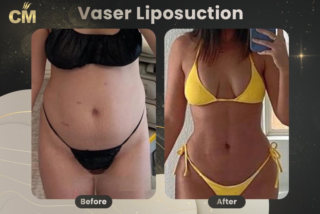 Vaser Liposuction Before and After-5