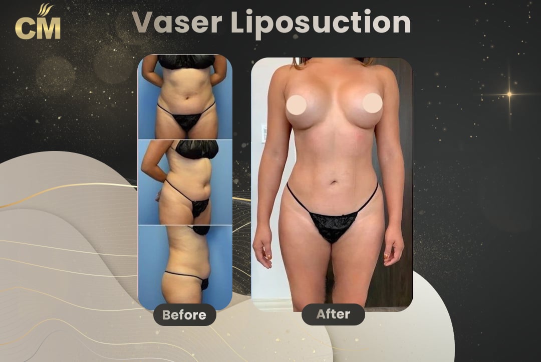 Vaser Liposuction Before and After-7