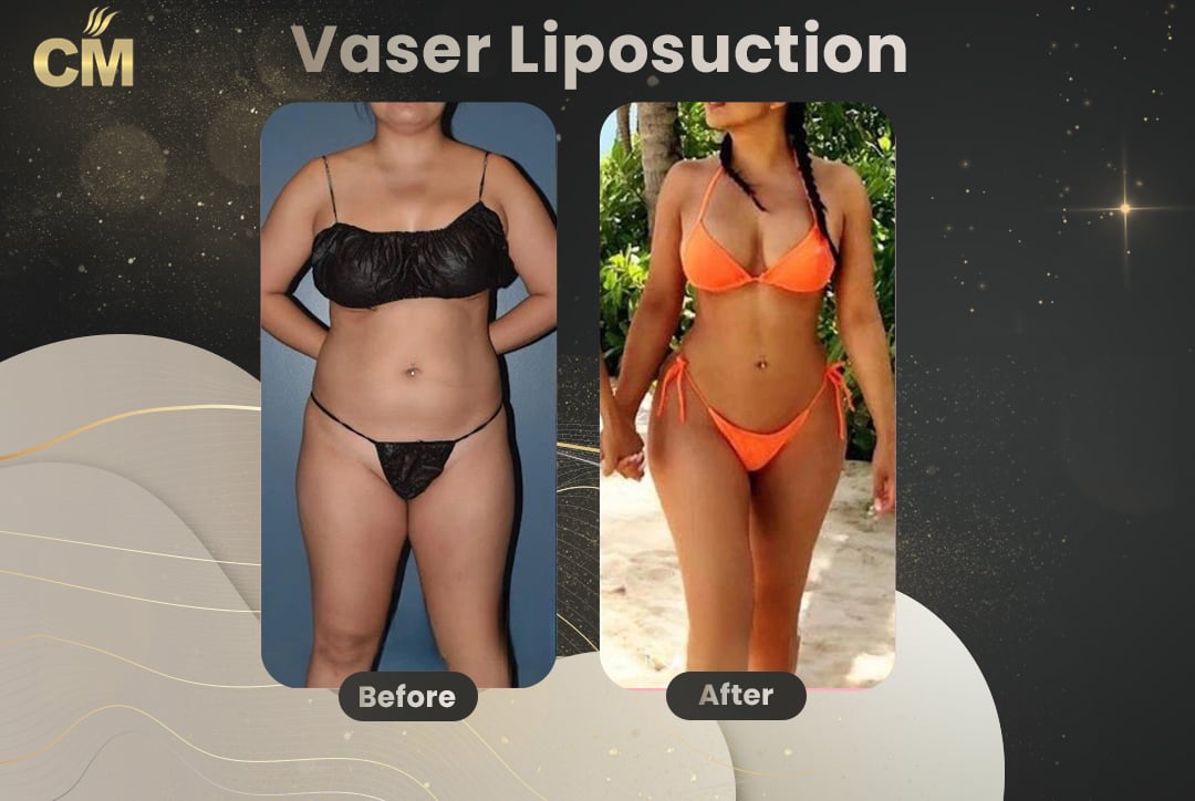 Vaser Liposuction Before and After-8