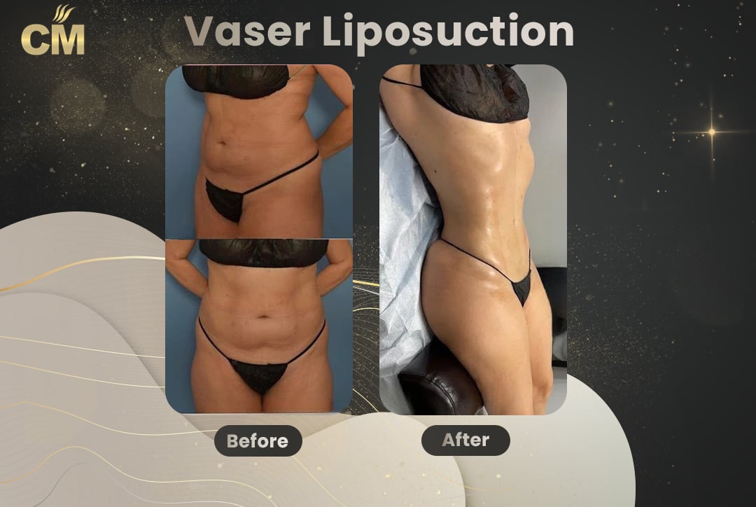 Vaser Liposuction Before and After-9