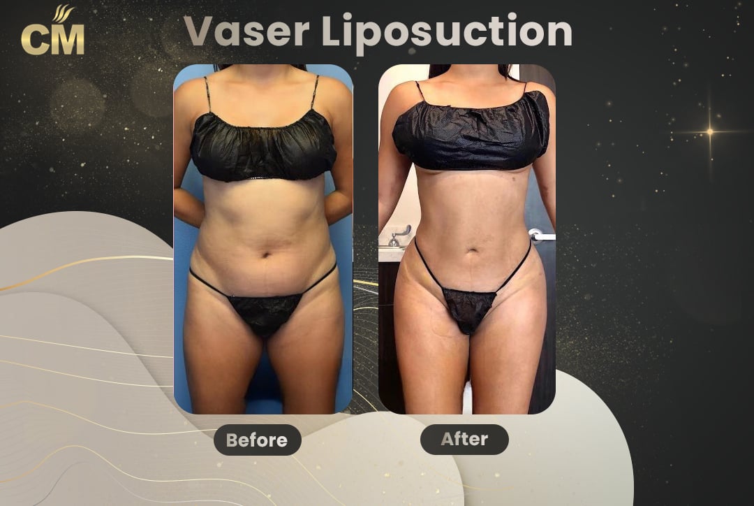 Vaser Liposuction Before and After-10