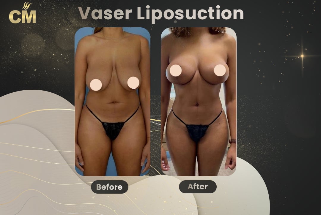 Vaser Liposuction Before and After-13