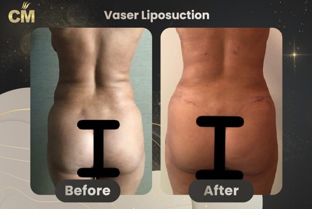 Vaser Liposuction Before and After