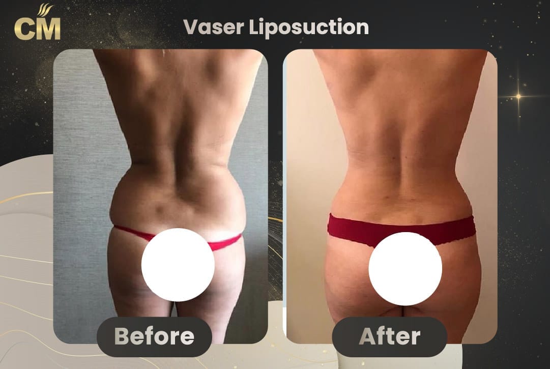Vaser Liposuction Before and After-3